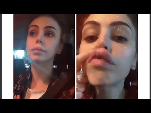 alessia-cammarota-labbra-filler