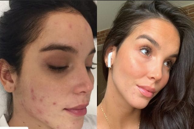 paola di benedetto brufoli acne 638x425 1