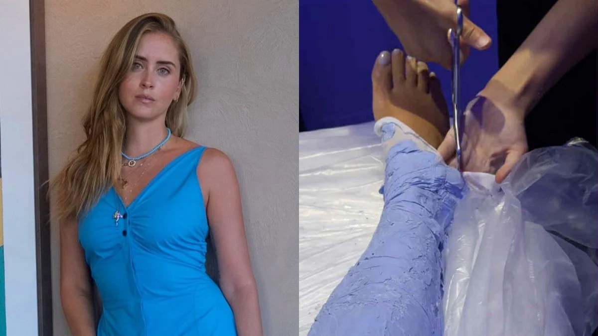 valentina ferragni trattamento gesso